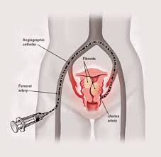 Why Choose Non-Surgical Fibroid Treatment in Bengaluru? download 27