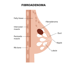 Best Breast Fibroadenoma Treatment in Bengaluru: Non-Surgical Options Explained images 1