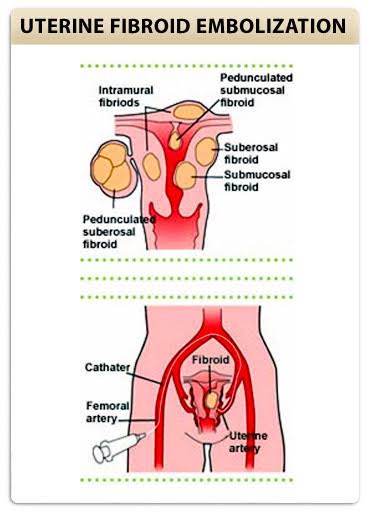 Why Choose Non-Surgical Fibroid Treatment in Bengaluru? images 19