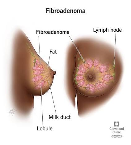 Best Breast Fibroadenoma Treatment in Bengaluru: Non-Surgical Options Explained images 9