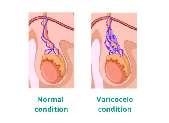 Varicocele 2