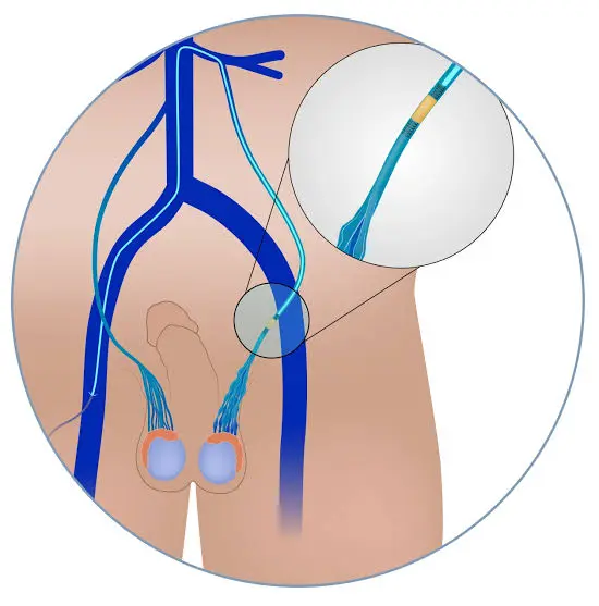 Varicocele Embolization