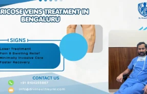 Varicose Veins Treatment in Bengaluru
