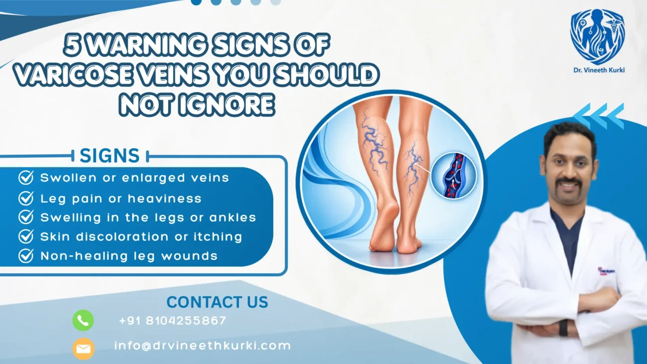5 Warning Signs of Varicose Veins
