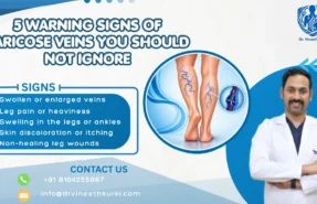 5 Warning Signs of Varicose Veins