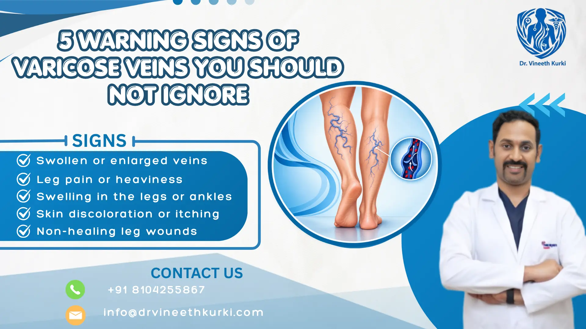 5 Warning Signs of Varicose Veins