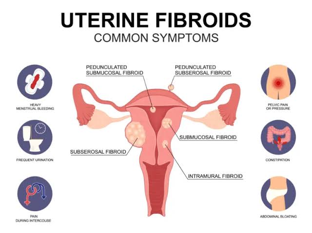 Symptoms and Causes of Uterine Fibroids