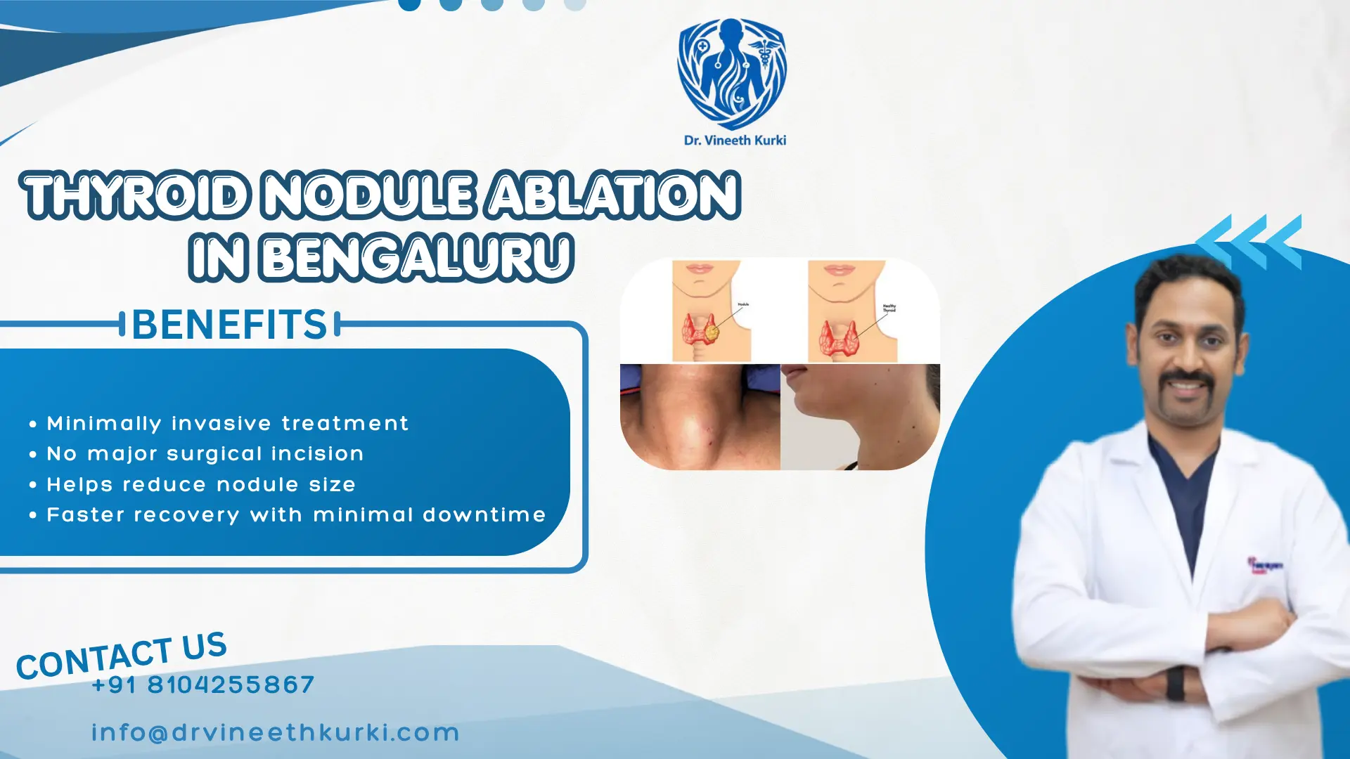 Thyroid Nodule Ablation in Bengaluru