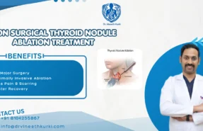 Non Surgical thyroid nodule ablation treatment